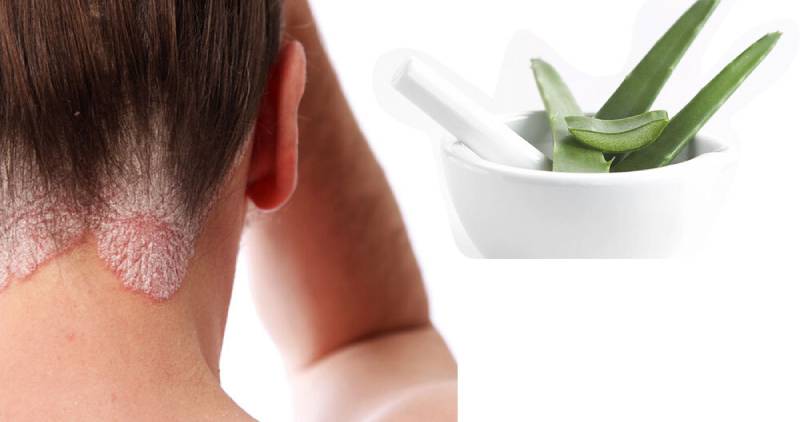 علاج التهاب فروة الرأس الدهنية بالأعشاب