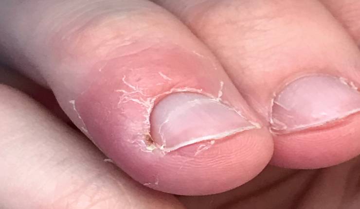 علاج تقشر جلد الأصابع حول الأظافر